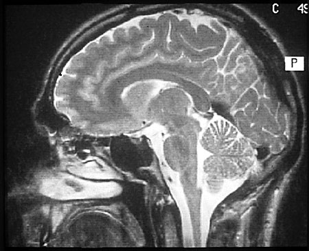 Image montrant en coupe les différentes parties d'une tête